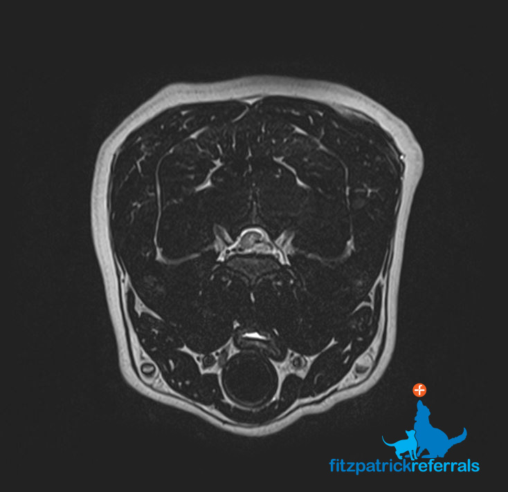 MRI scan of Labrador with Intervertebral Disc Disease - disc material visible on left side of canal