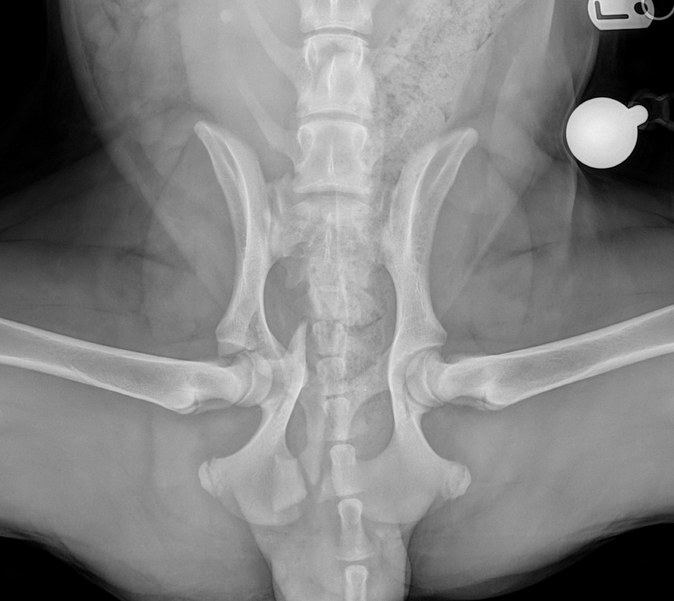 Radiograph of a pelvic fracture before and after specialist surgery