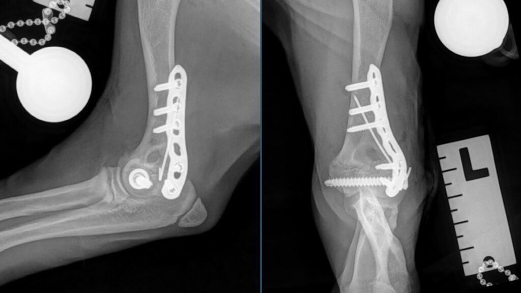 Postoperative radiographs of a puppy's humeral condylar fracture.