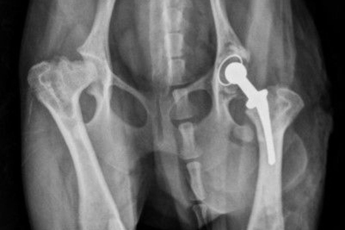 Total hip replacement - Fitzpatrick Referrals